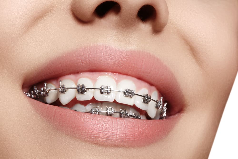 Types of Braces